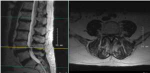 X-rays and MRI of the Lumbar spine showed L4-5 degenerative spondylolisthesis 
