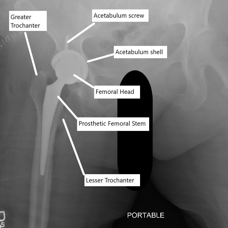 X-ray showing total hip replacement. X-ray showing total hip replacement.