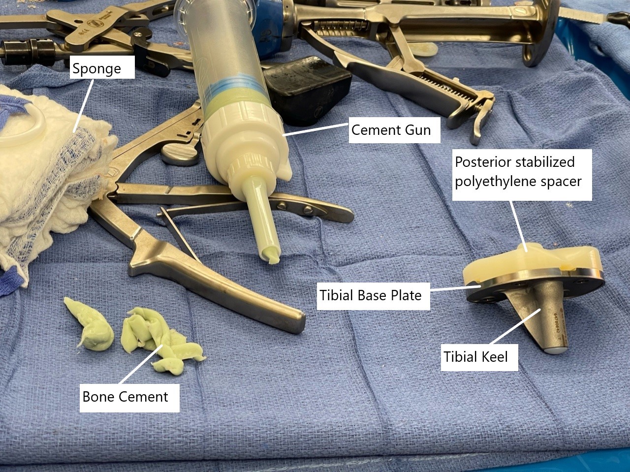 Intraoperative image showing the tibial component with polyethylene spacer.