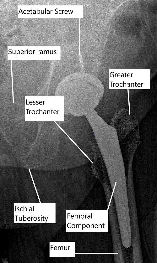 X-ray showing a total hip replacement. X-ray showing a total hip replacement.